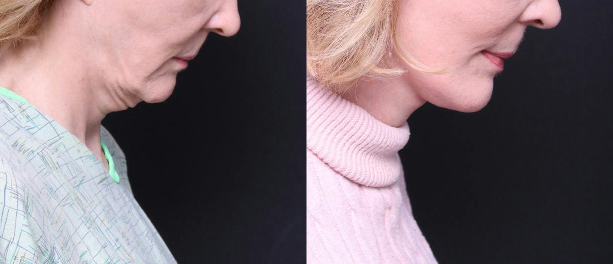 Deep Plane Facelift Before & After Gallery - Patient 674319 - Image 4