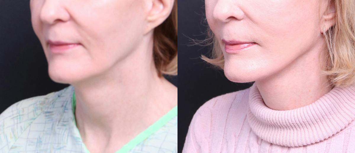Deep Plane Facelift Before & After Gallery - Patient 674319 - Image 5