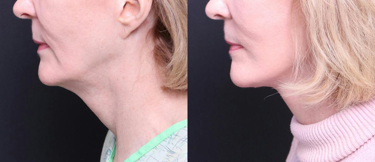 Deep Plane Facelift Before & After Gallery - Patient 674319 - Image 6