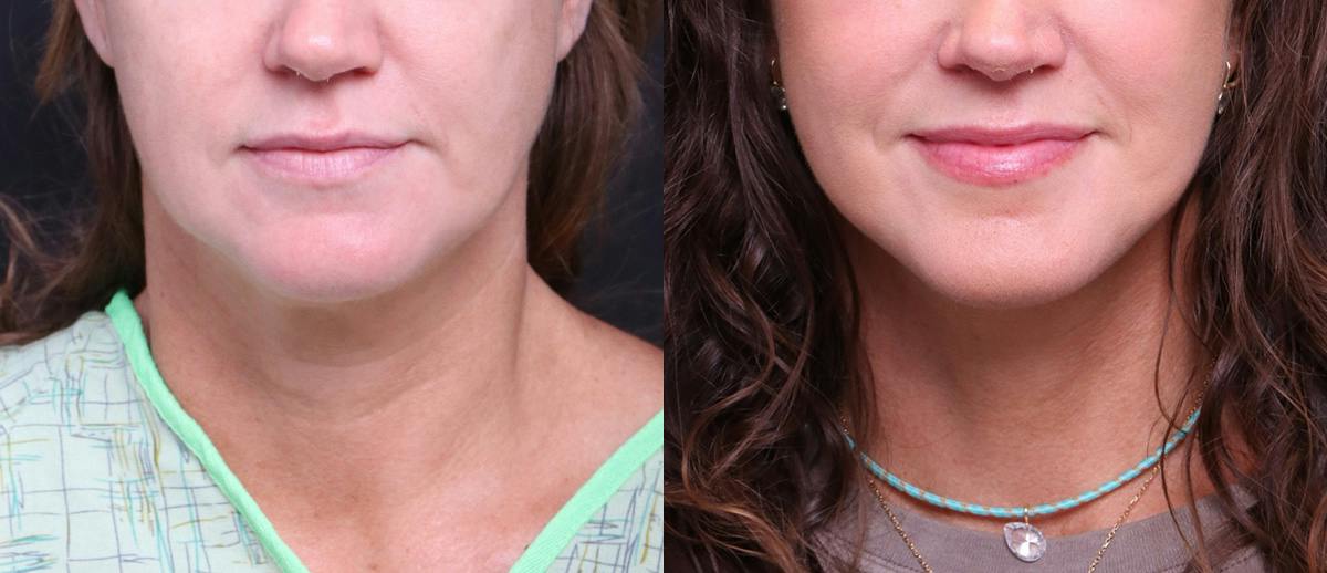 Deep Plane Facelift Before & After Gallery - Patient 949357 - Image 1