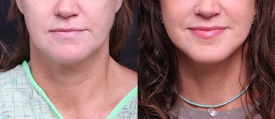 Deep Plane Facelift Before & After Gallery - Patient 949357 - Image 1