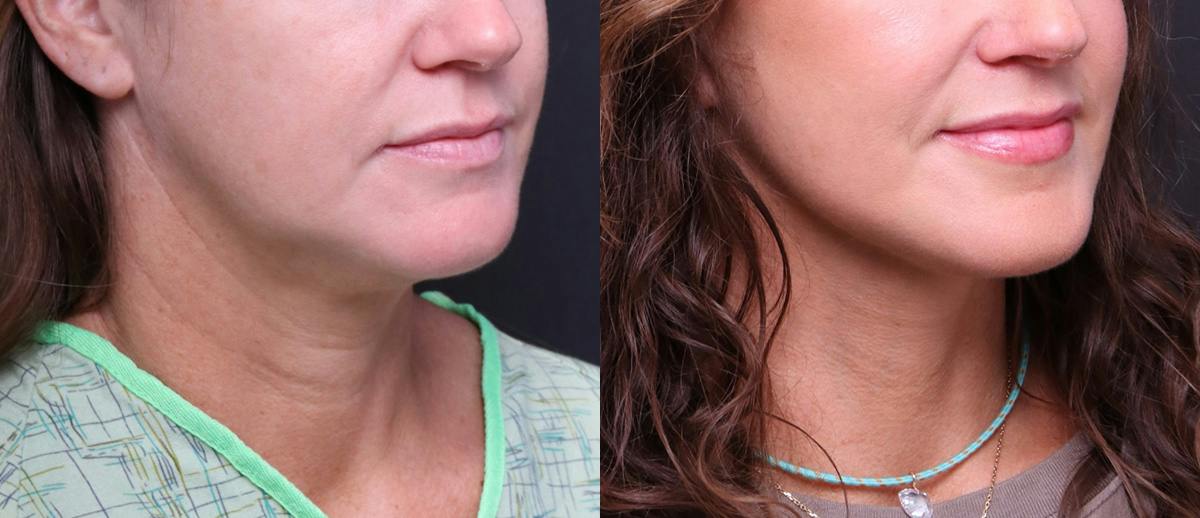 Deep Plane Facelift Before & After Gallery - Patient 949357 - Image 2