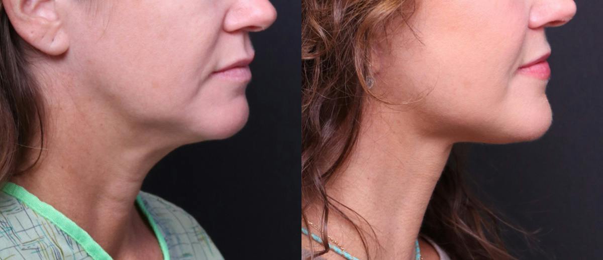 Deep Plane Facelift Before & After Gallery - Patient 949357 - Image 4