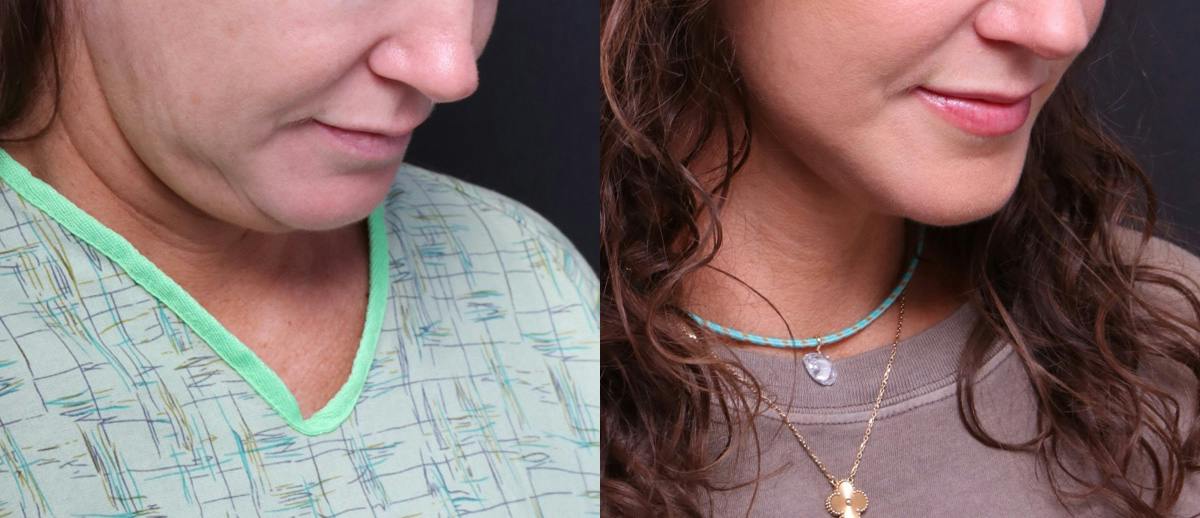 Deep Plane Facelift Before & After Gallery - Patient 949357 - Image 3