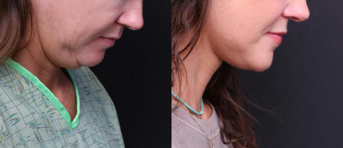 Deep Plane Facelift Before & After Gallery - Patient 949357 - Image 5