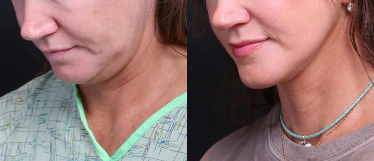 Deep Plane Facelift Before & After Gallery - Patient 949357 - Image 7