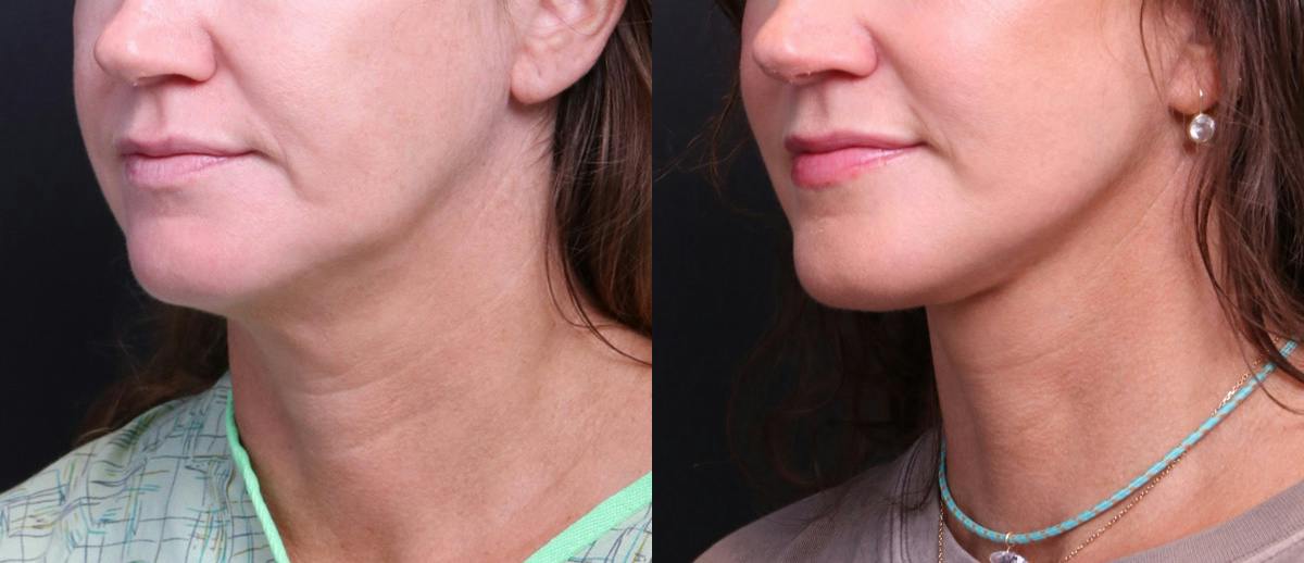 Deep Plane Facelift Before & After Gallery - Patient 949357 - Image 6