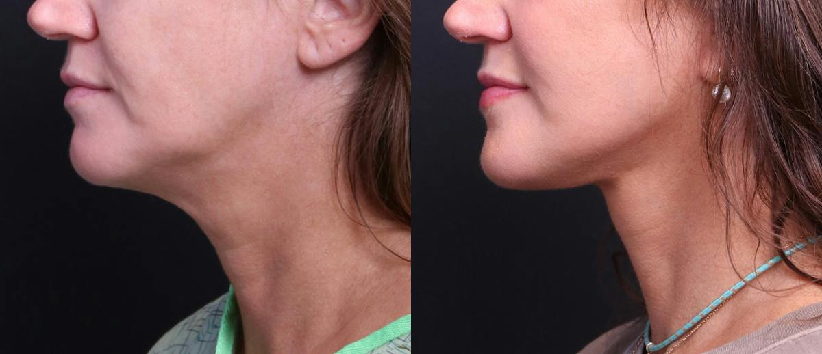 Deep Plane Facelift Before & After Gallery - Patient 949357 - Image 8