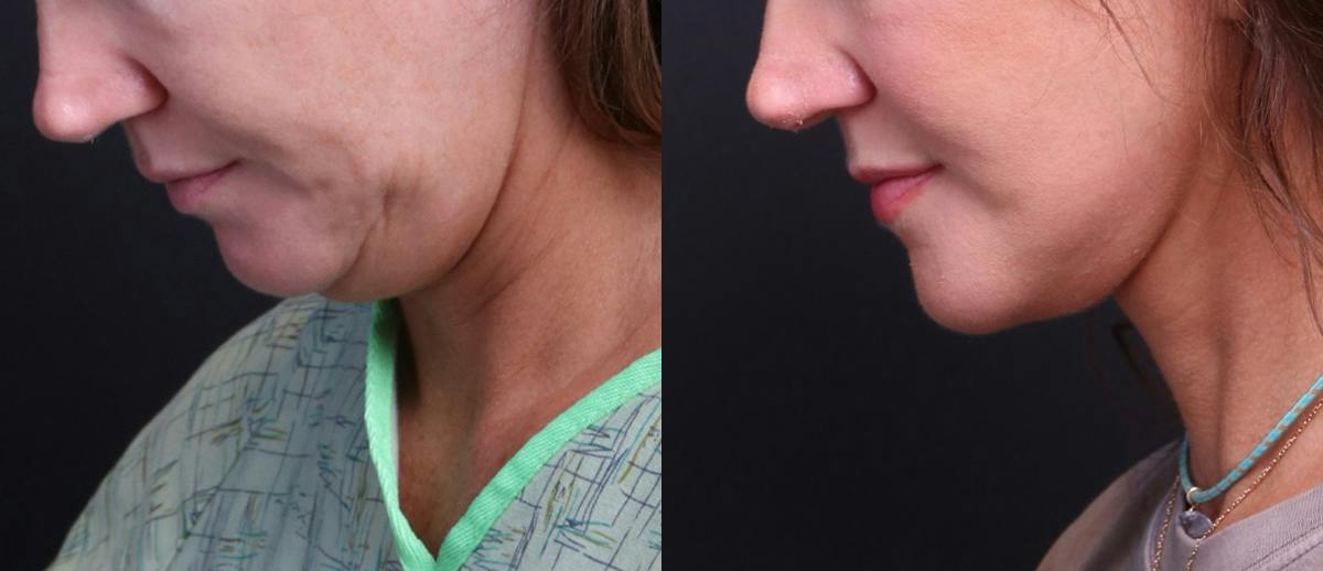 Deep Plane Facelift Before & After Gallery - Patient 949357 - Image 9