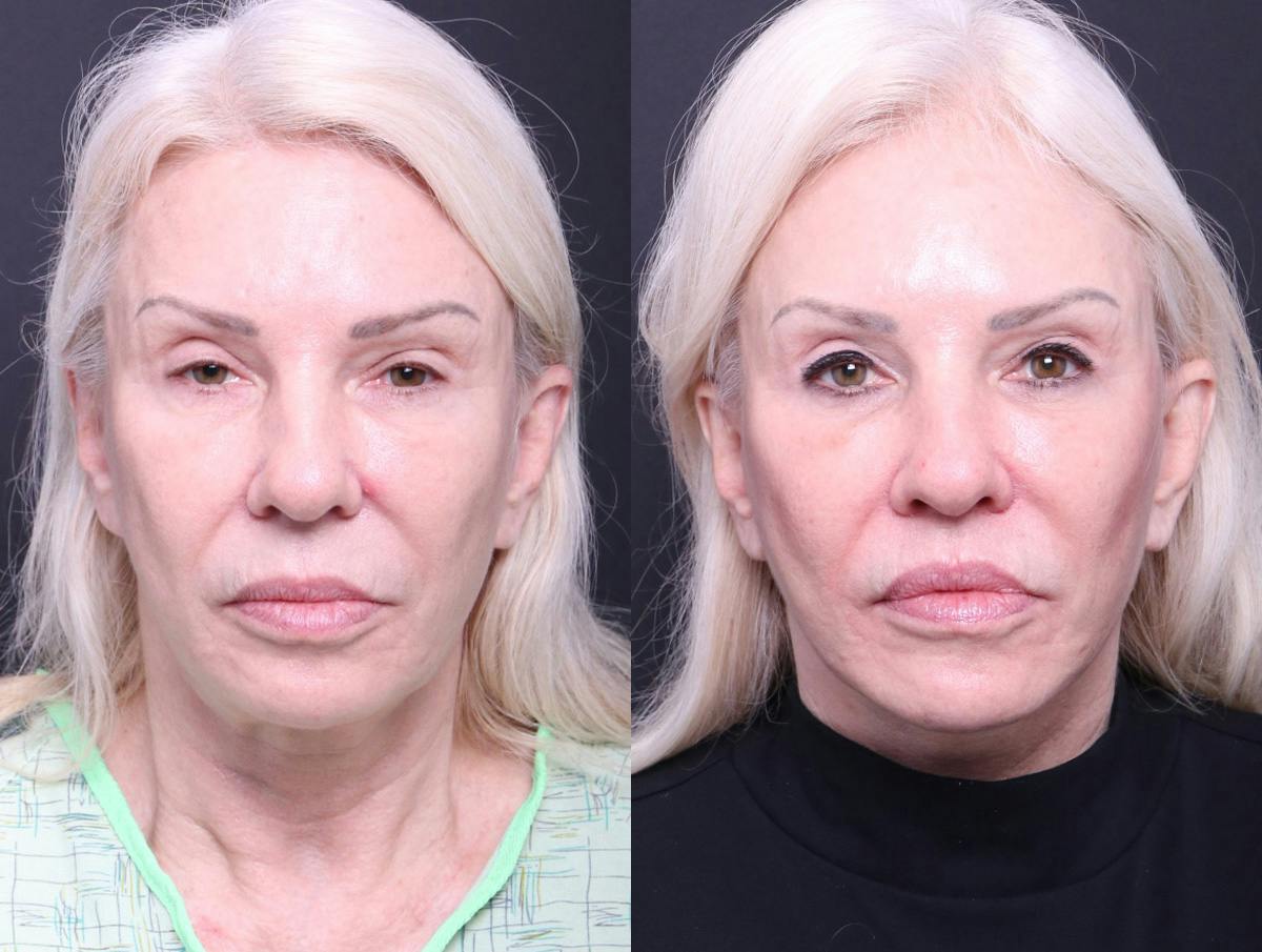 Deep Plane Facelift Before & After Gallery - Patient 489768 - Image 1