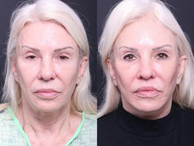 Deep Plane Facelift Before & After Gallery - Patient 489768 - Image 1