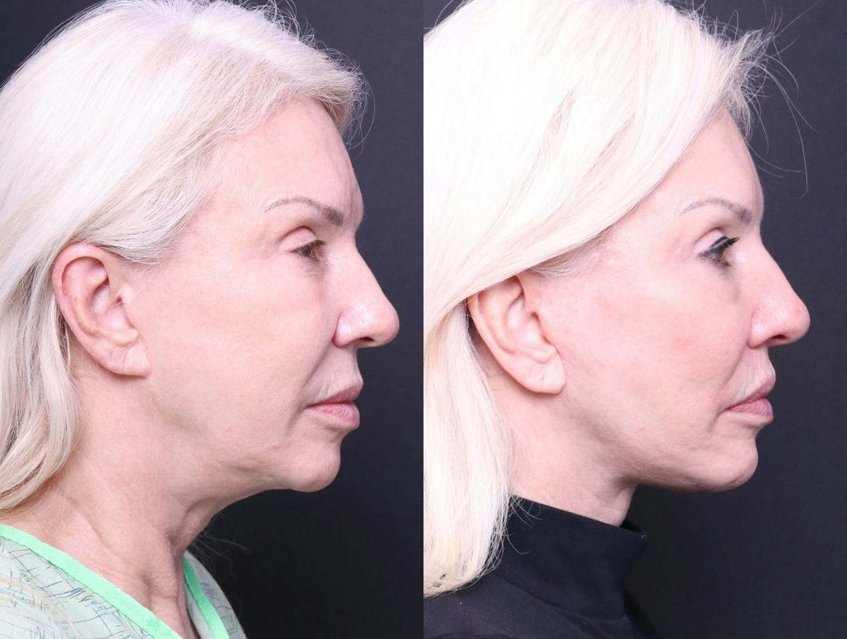 Deep Plane Facelift Before & After Gallery - Patient 489768 - Image 3