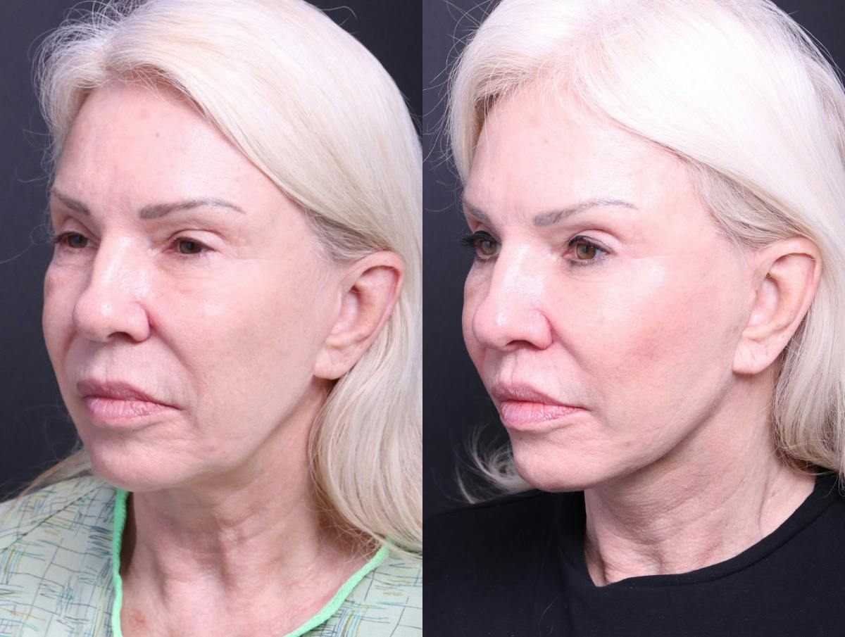 Deep Plane Facelift Before & After Gallery - Patient 489768 - Image 4