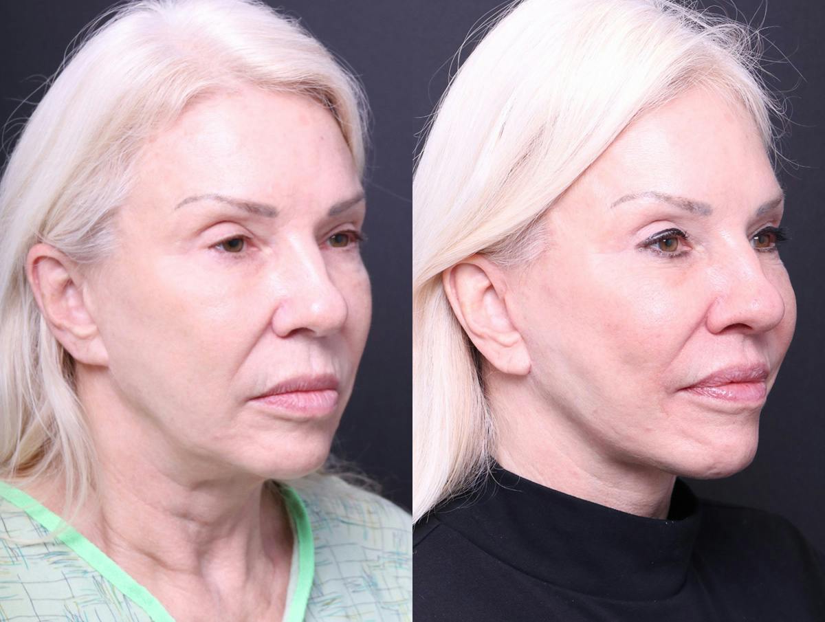 Deep Plane Facelift Before & After Gallery - Patient 489768 - Image 2