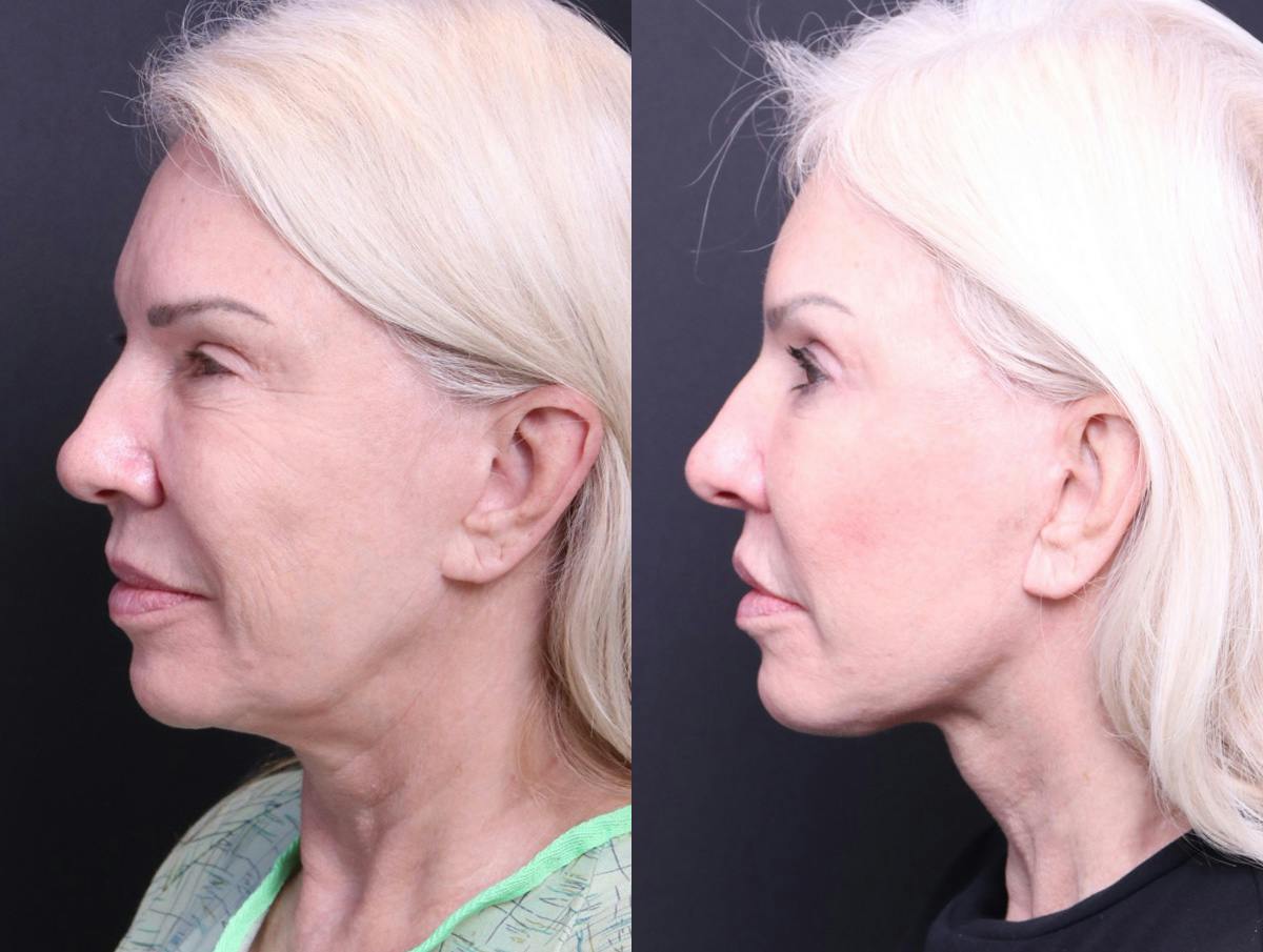 Deep Plane Facelift Before & After Gallery - Patient 489768 - Image 5