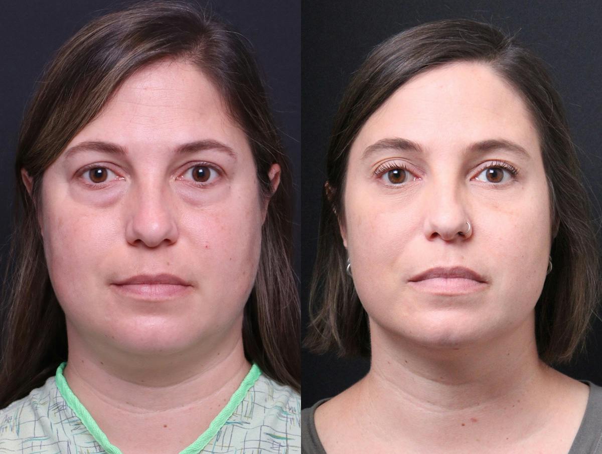 Blepharoplasty Before & After Gallery - Patient 282982 - Image 1
