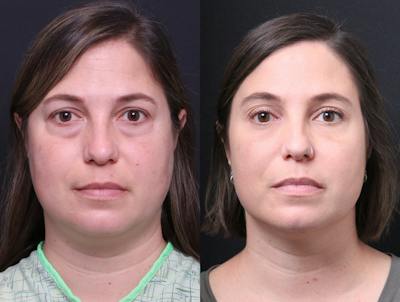 Blepharoplasty Before & After Gallery - Patient 282982 - Image 1