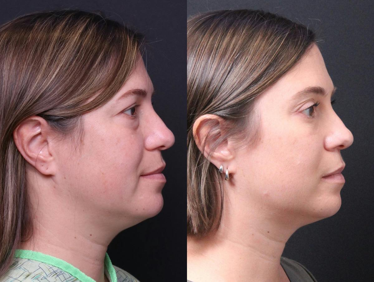 Blepharoplasty Before & After Gallery - Patient 282982 - Image 3
