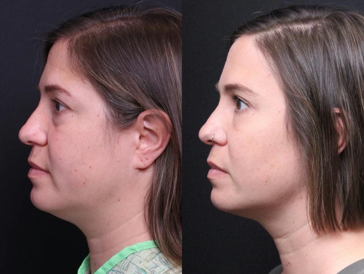 Blepharoplasty Before & After Gallery - Patient 282982 - Image 5