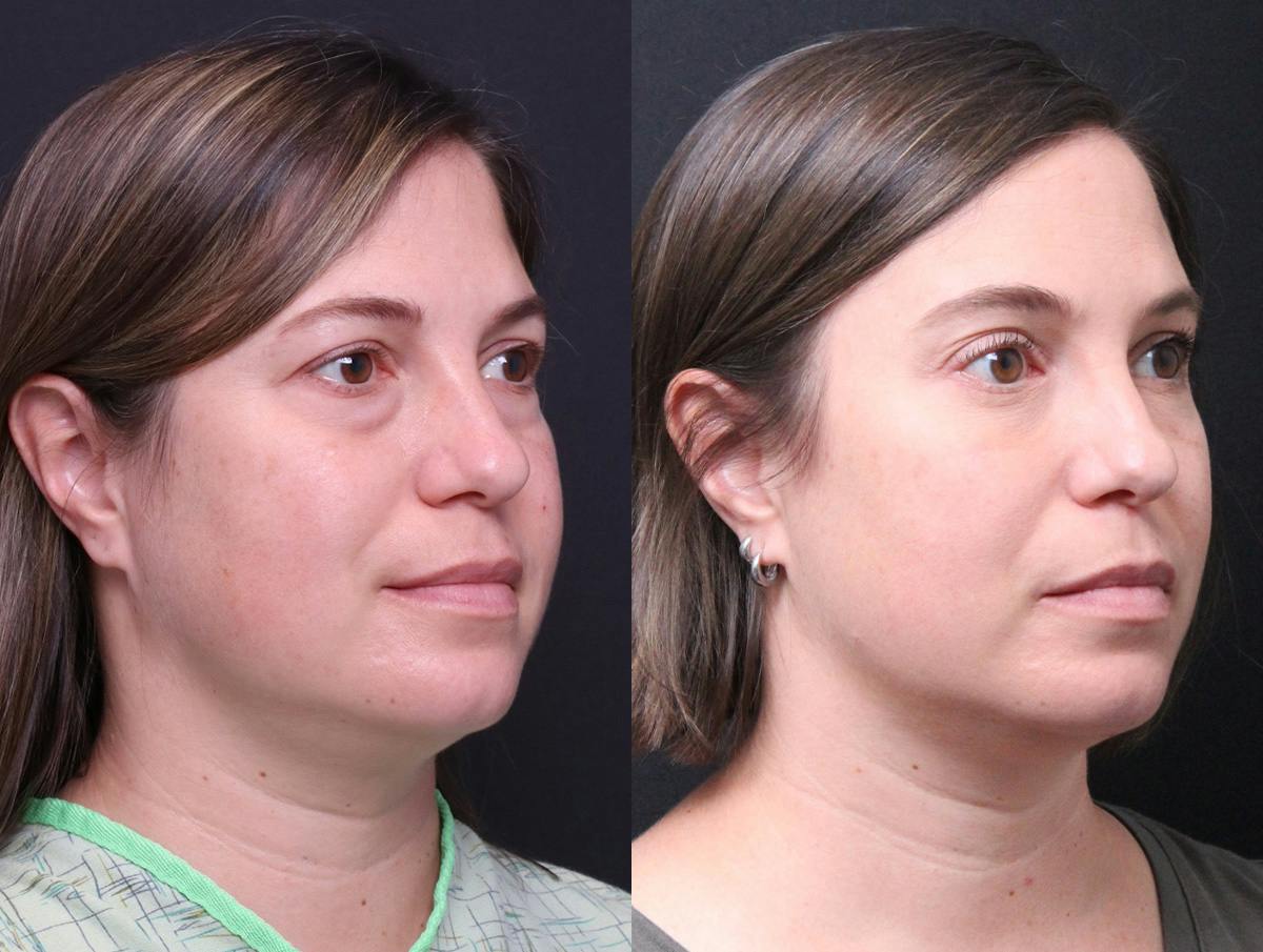 Blepharoplasty Before & After Gallery - Patient 282982 - Image 2