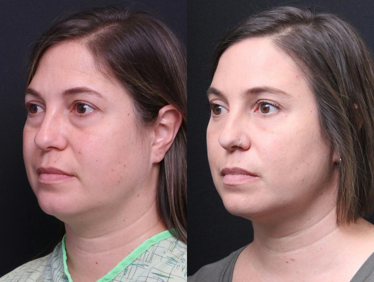 Blepharoplasty Before & After Gallery - Patient 282982 - Image 4