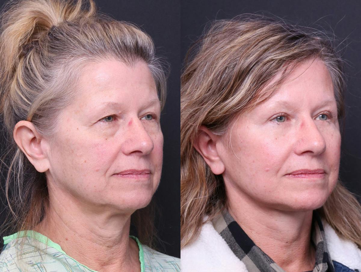 Neck Lift Before & After Gallery - Patient 107778 - Image 2