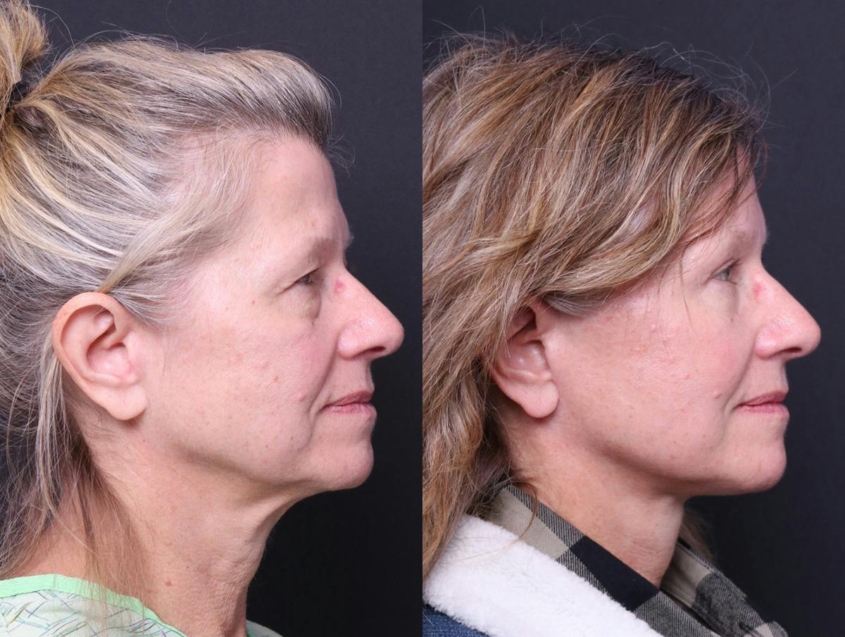 Neck Lift Before & After Gallery - Patient 107778 - Image 3