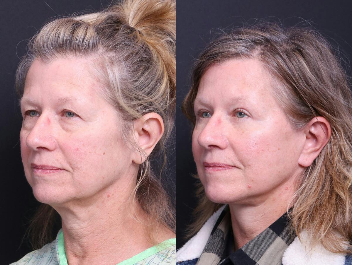 Neck Lift Before & After Gallery - Patient 107778 - Image 4