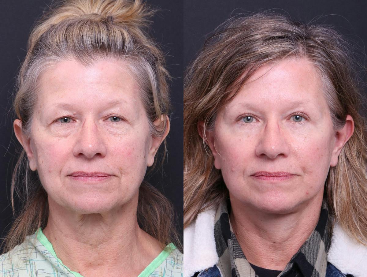 Neck Lift Before & After Gallery - Patient 107778 - Image 1