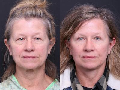 Deep Plane Facelift Before & After Gallery - Patient 390944 - Image 1