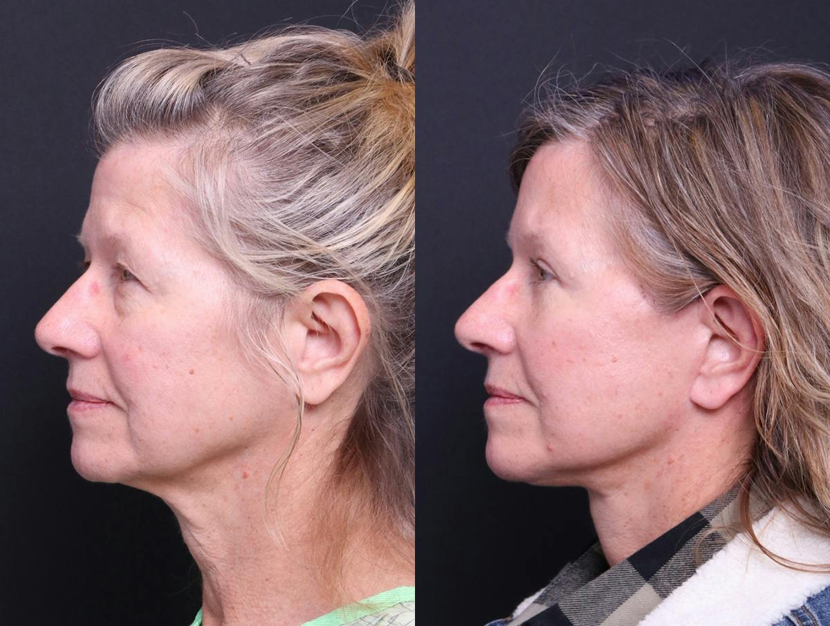 Neck Lift Before & After Gallery - Patient 107778 - Image 5