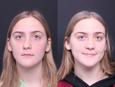 Rhinoplasty Before & After Gallery - Patient 114935 - Image 1