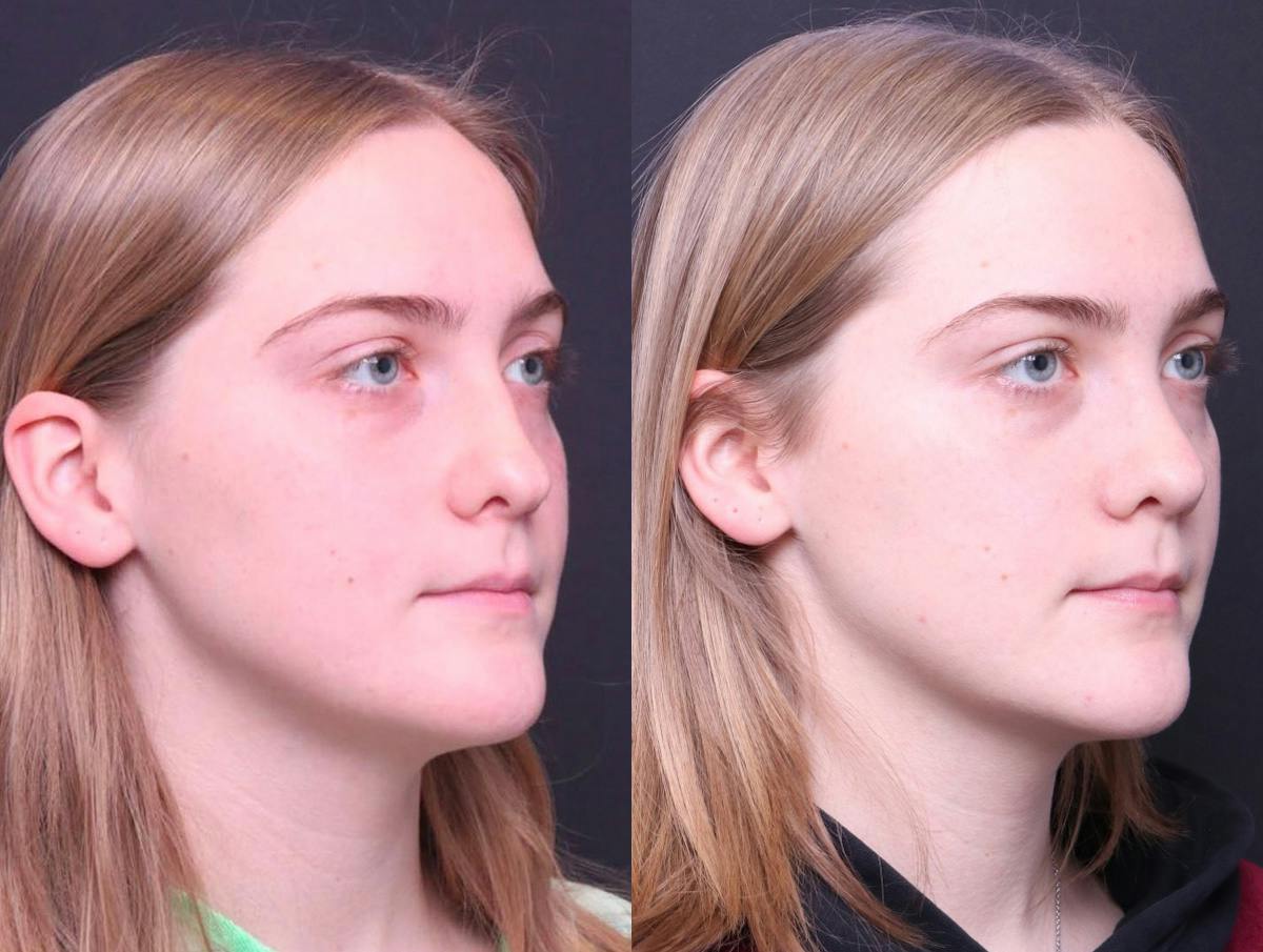 Rhinoplasty Before & After Gallery - Patient 114935 - Image 2