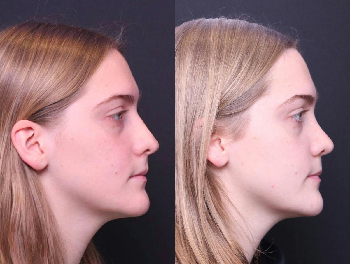 Rhinoplasty Before & After Gallery - Patient 114935 - Image 3
