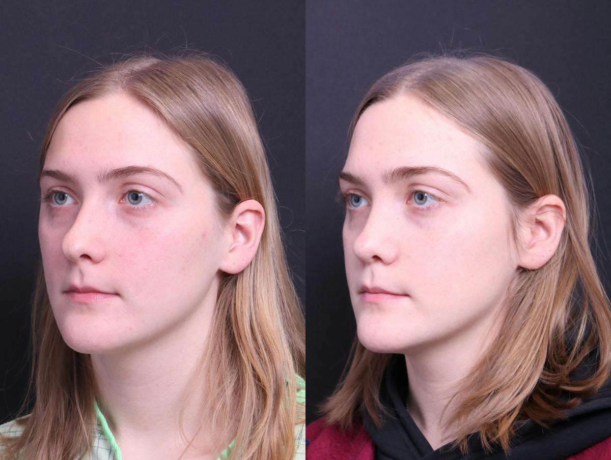 Rhinoplasty Before & After Gallery - Patient 114935 - Image 4