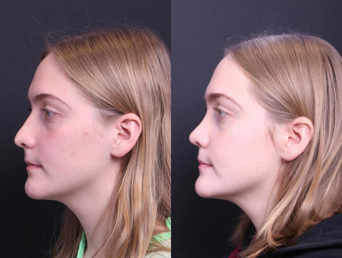Rhinoplasty Before & After Gallery - Patient 114935 - Image 5