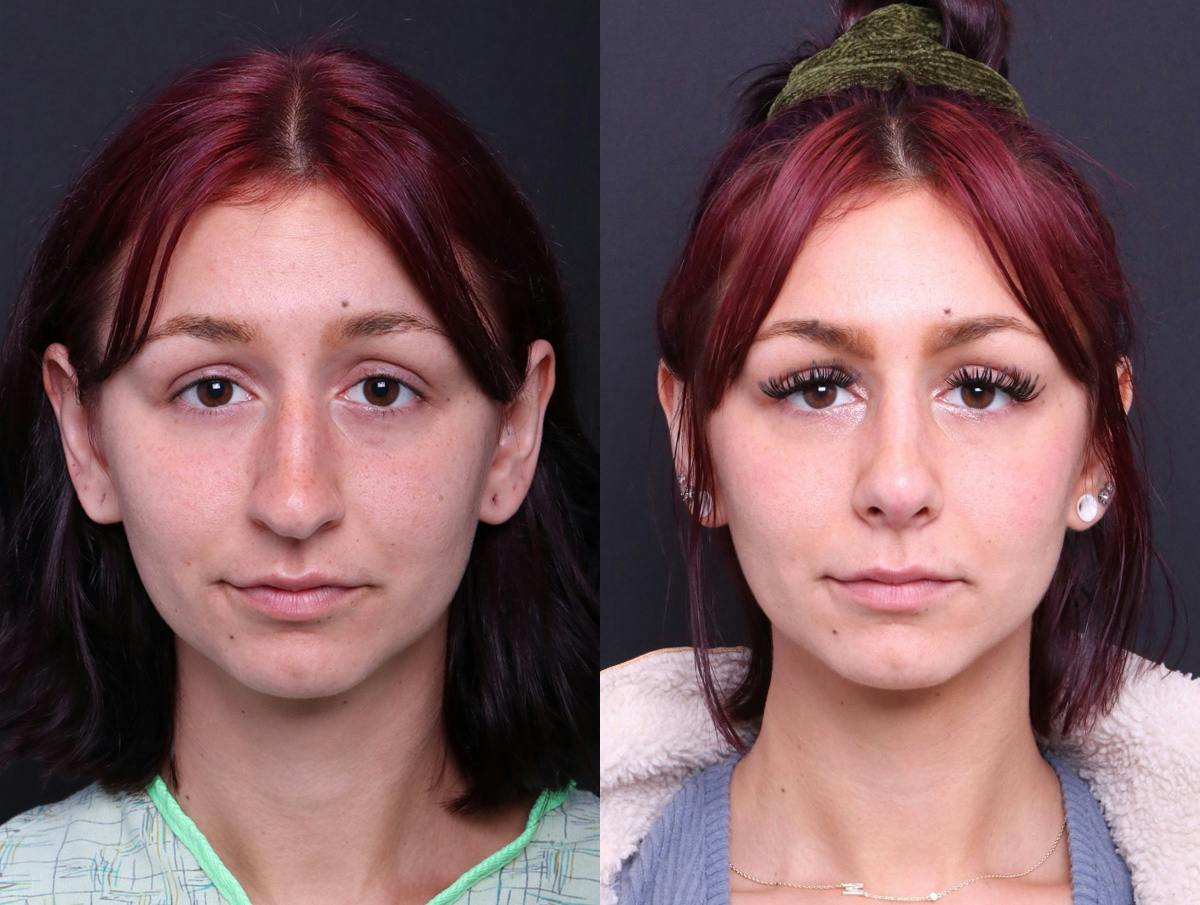Rhinoplasty Before & After Gallery - Patient 278615 - Image 1
