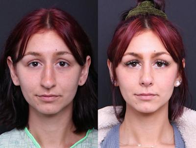 Rhinoplasty Before & After Gallery - Patient 278615 - Image 1