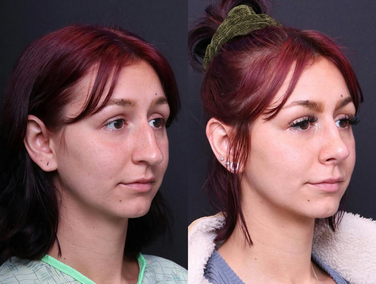 Rhinoplasty Before & After Gallery - Patient 278615 - Image 2