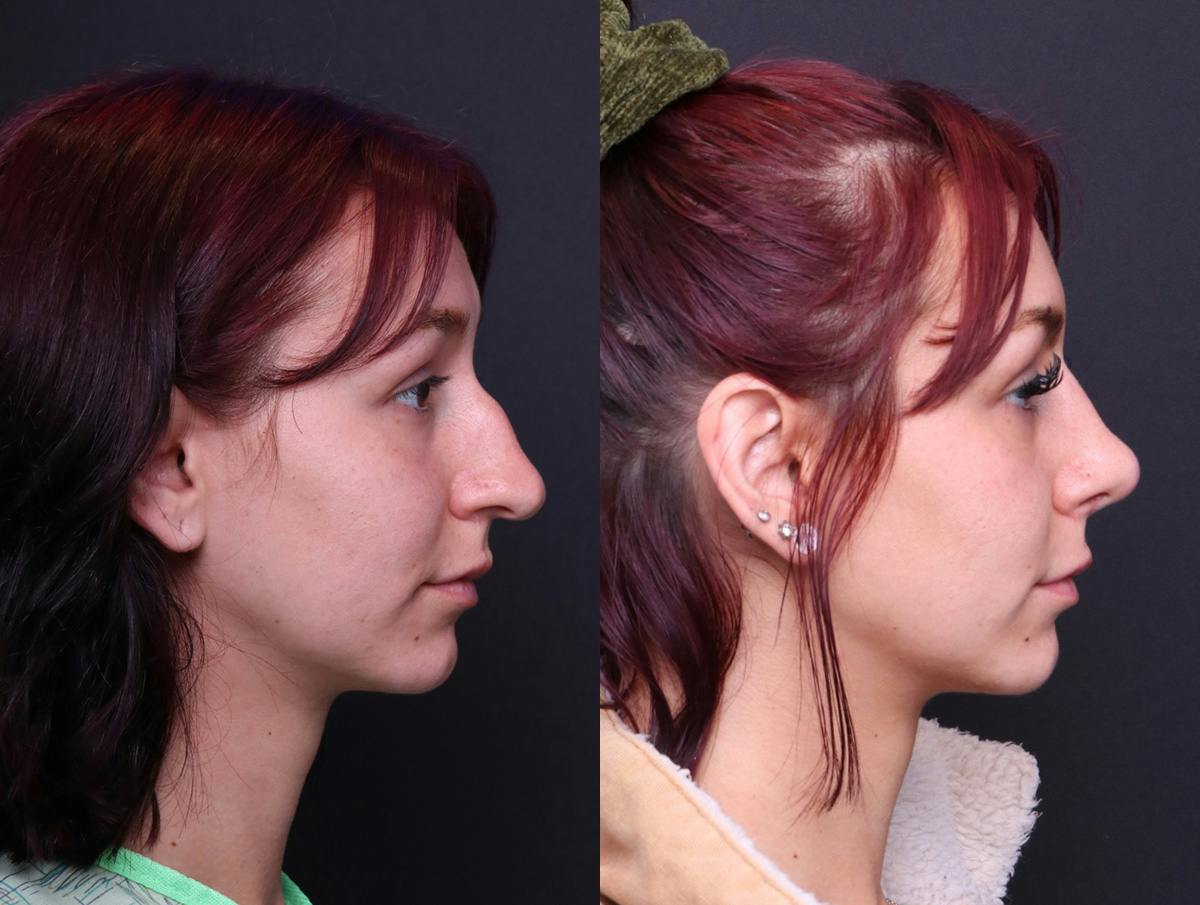 Rhinoplasty Before & After Gallery - Patient 278615 - Image 3