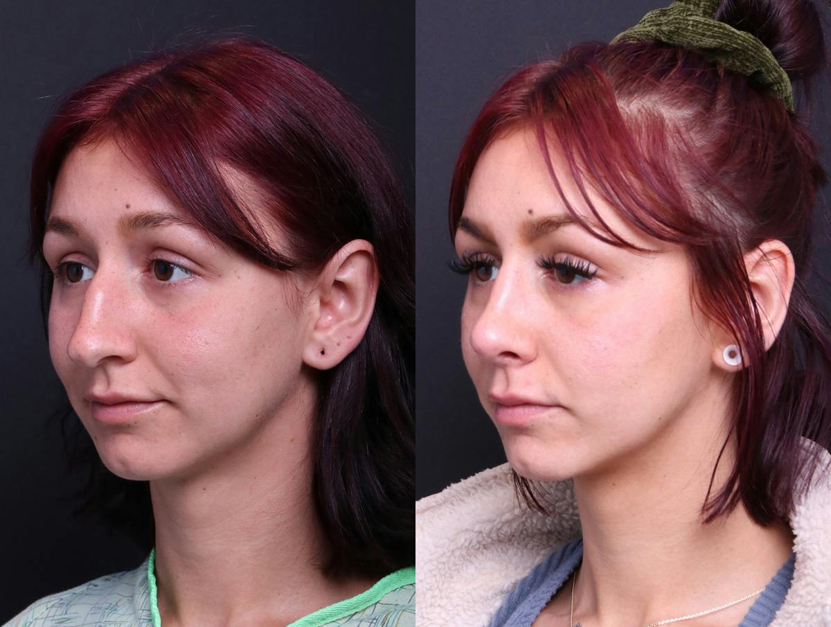 Rhinoplasty Before & After Gallery - Patient 278615 - Image 4