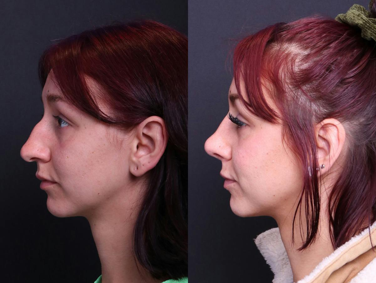 Rhinoplasty Before & After Gallery - Patient 278615 - Image 5