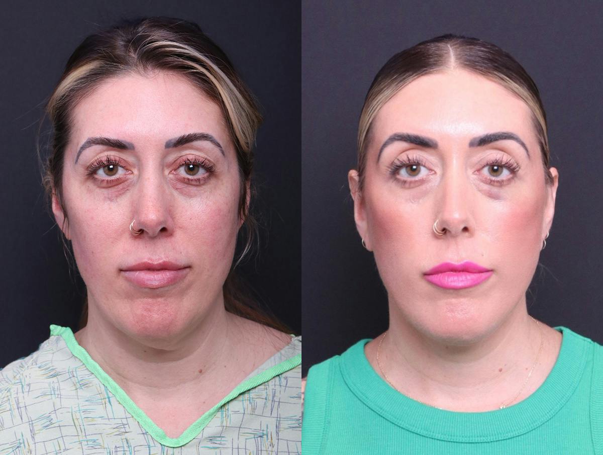 Deep Plane Facelift Before & After Gallery - Patient 391757 - Image 1
