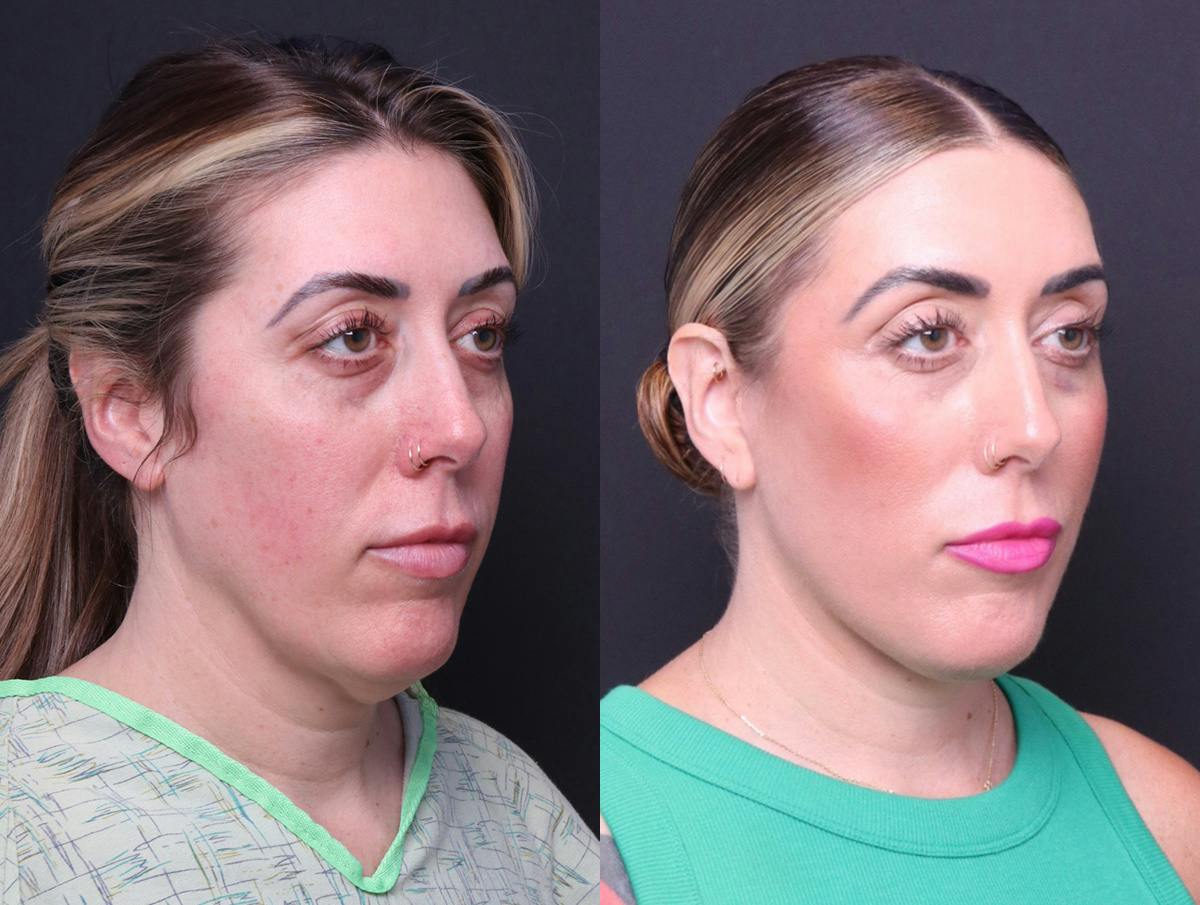 Deep Plane Facelift Before & After Gallery - Patient 391757 - Image 2