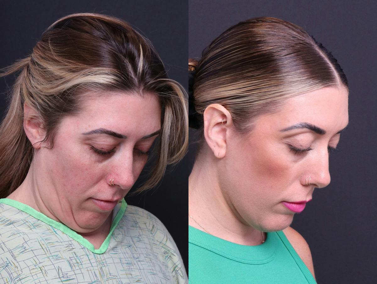 Deep Plane Facelift Before & After Gallery - Patient 391757 - Image 3