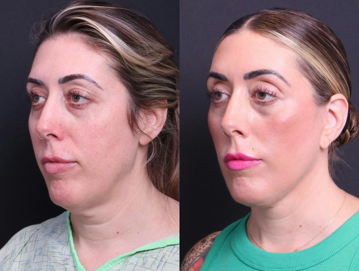 Deep Plane Facelift Before & After Gallery - Patient 391757 - Image 4