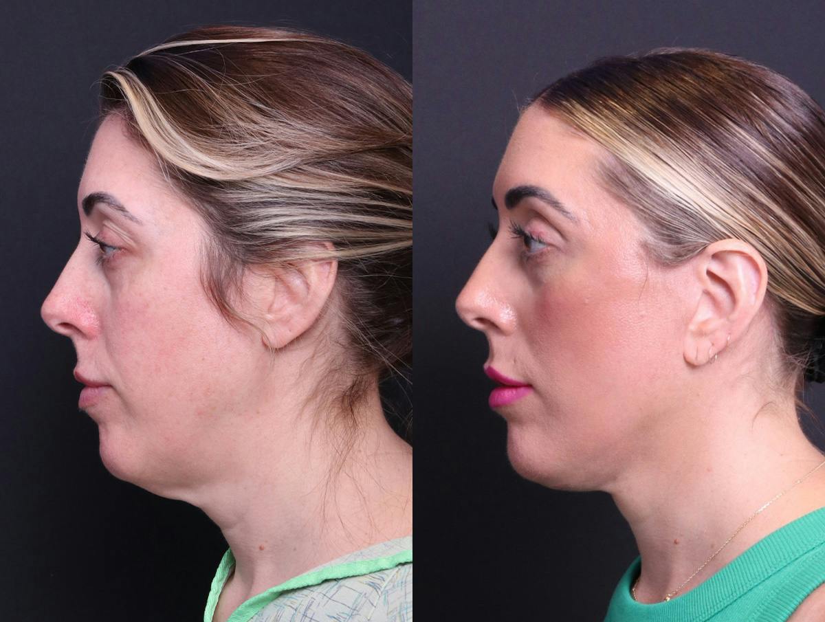 Deep Plane Facelift Before & After Gallery - Patient 391757 - Image 5