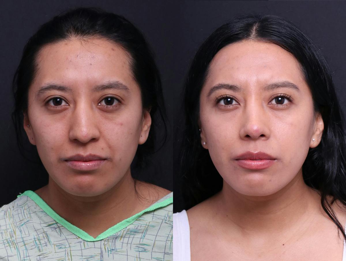 Rhinoplasty Before & After Gallery - Patient 372630 - Image 1