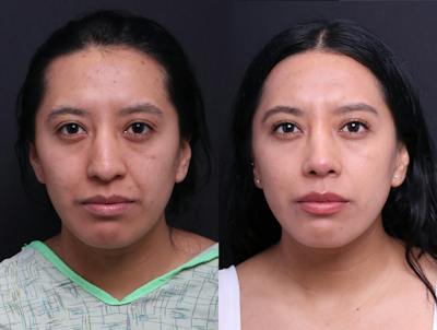 Rhinoplasty Before & After Gallery - Patient 372630 - Image 1