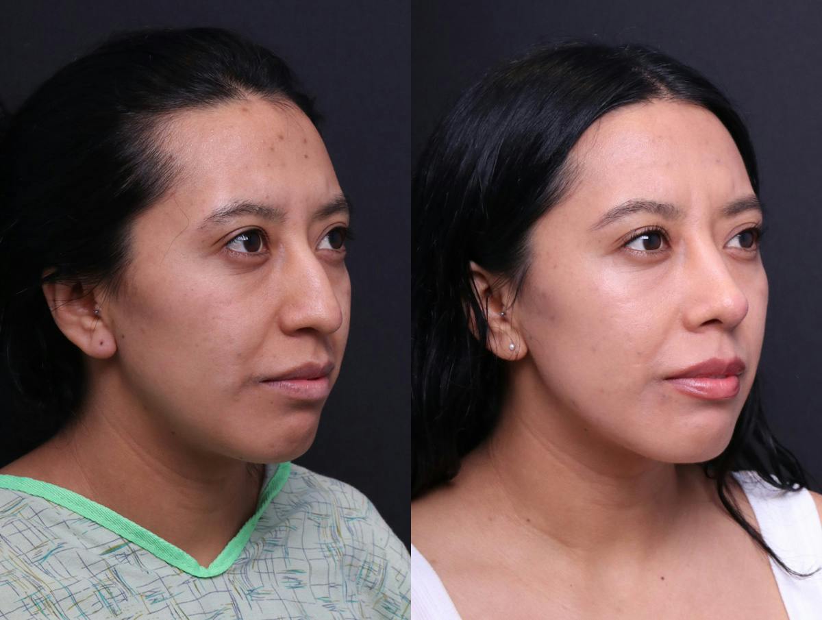 Rhinoplasty Before & After Gallery - Patient 372630 - Image 2